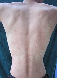 Person's back with red spots from drinking alcohol